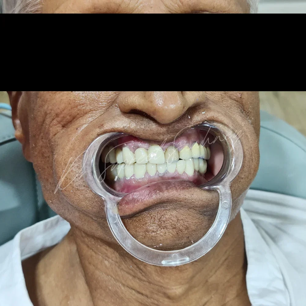 Frontal retracted intraoral photograph after full-arch restorative rehabilitation